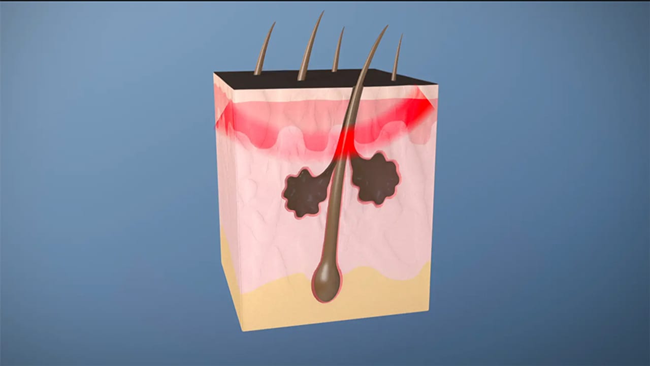 Sebacia | Medical Process Animation animation or motion graphics frame showing designed visual storytelling and production polish.